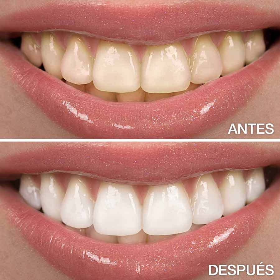 Blanqueamiento Dental